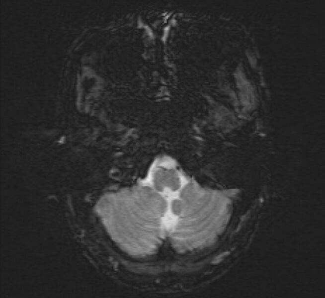 File:Cerebral venous thrombosis (Radiopaedia 71207-81504 Axial SWI 4).jpg