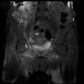 Cervical carcinoma (Radiopaedia 78847-91705 Coronal T2 fat sat 6).jpg