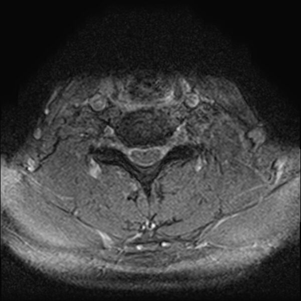 File:Cervical compressive myelopathy (Radiopaedia 71956-82411 Axial 3D-T2* 23).jpg