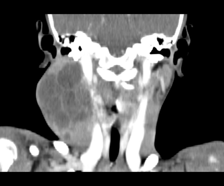 File:Cervical cystic lymphangioma (Radiopaedia 63655-72332 Coronal + contrast 22).jpg
