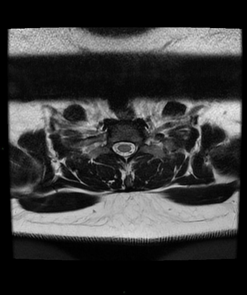 Cervical disc prolapse (Radiopaedia 80258-93598 Axial T2 77).jpg