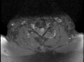 Cervical schwannoma (Radiopaedia 72399-82934 Axial T1 C+ fat sat 13).jpg