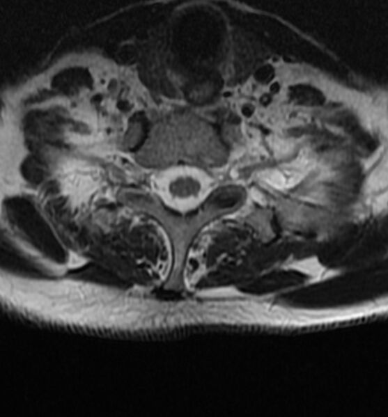 File:Cervical spondylodiscitis (Radiopaedia 81362-95110 Axial T2 19).jpg