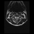 Cervical vertebrae metastasis (Radiopaedia 78814-91667 Axial T2 19).png