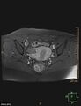 Cesarian scar endometriosis (Radiopaedia 68495-78066 Axial T1 C+ fat sat 14).jpg