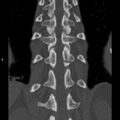 Chance fracture (Radiopaedia 36521-38081 Coronal bone window 45).jpg