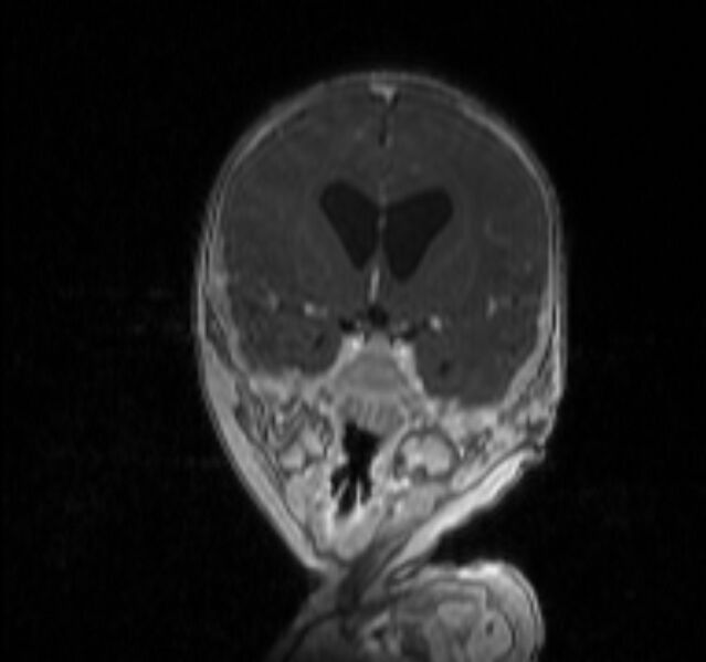 File:Chiari III malformation with occipital encephalocele (Radiopaedia 79446-92559 Coronal T1 C+ mpr 9).jpg