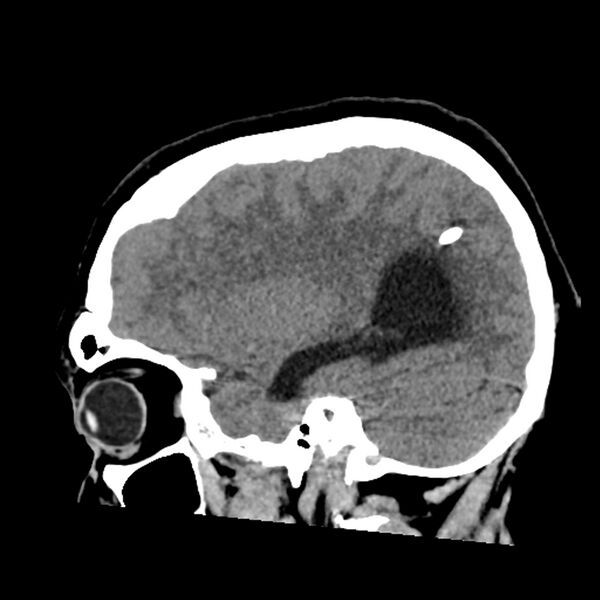 File:Chiasmatic-hypothalamic juvenile pilocytic astrocytoma (Radiopaedia 78533-91237 B 44).jpg