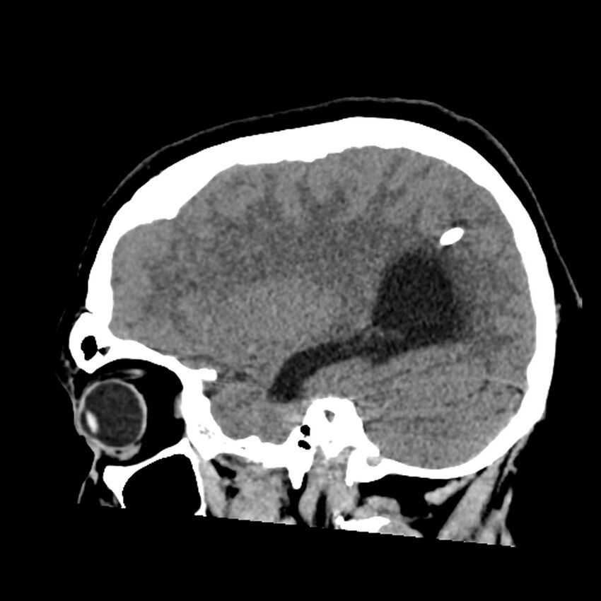 Chiasmatic-hypothalamic juvenile pilocytic astrocytoma (Radiopaedia 78533-91237 B 44).jpg