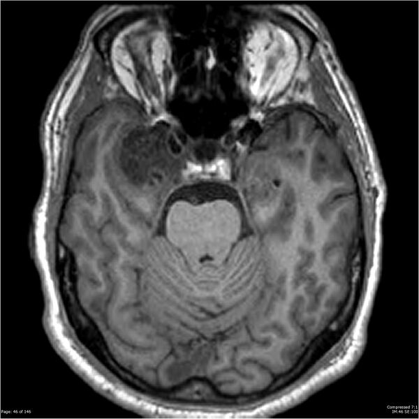 File:Chondrosarcoma of skull base- grade II (Radiopaedia 40948-43654 Axial T1 46).jpg