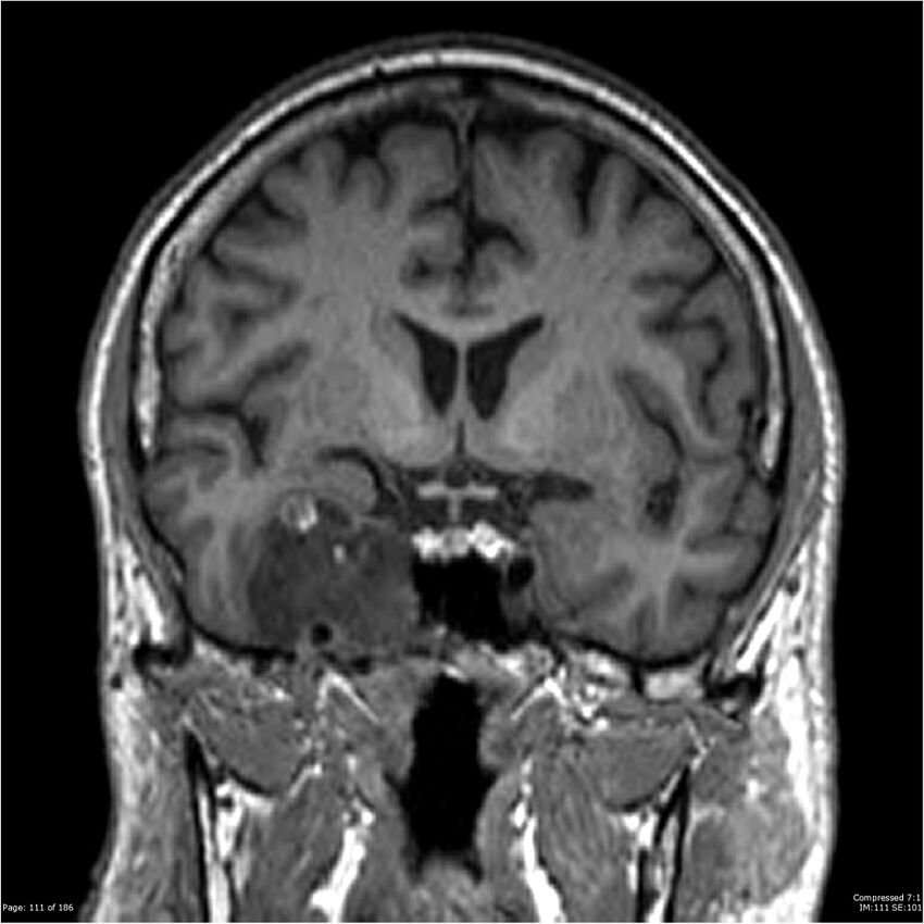 Chondrosarcoma of skull base- grade II (Radiopaedia 40948-43654 Coronal T1 32).jpg