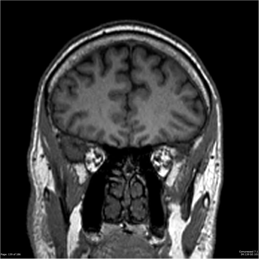 Chondrosarcoma of skull base- grade II (Radiopaedia 40948-43654 Coronal T1 60).jpg