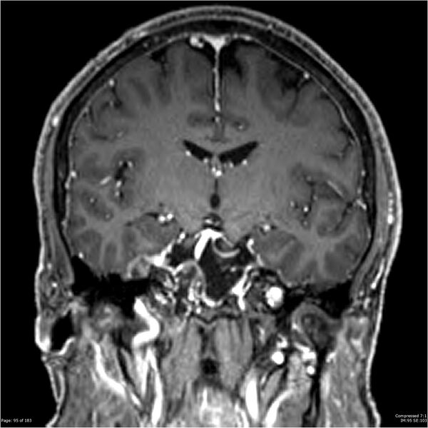 File:Chondrosarcoma of skull base- grade II (Radiopaedia 40948-43654 Coronal T1 C+ 6).jpg