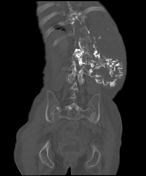 File:Chondrosarcoma of the spine (Radiopaedia 49871-55143 Coronal bone window 7).jpg