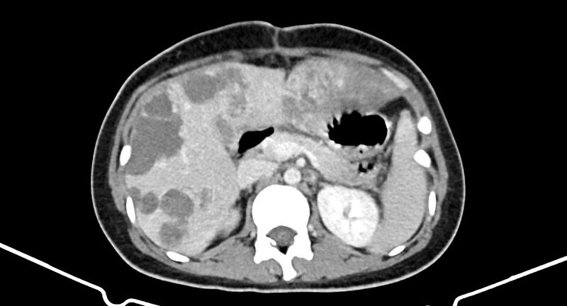 File:Choriocarcinoma liver metastases (Radiopaedia 74768-85766 A 79).jpg