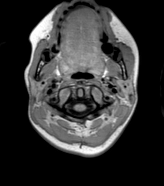 File:Choroid plexus carcinoma (Radiopaedia 91013-108553 Axial T1 12).jpg