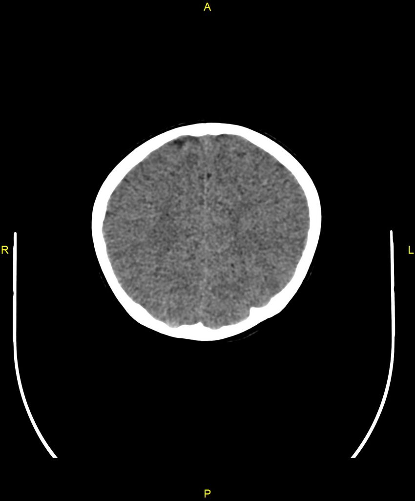Choroidal fissure cyst (Radiopaedia 89481-106465 Axial non-contrast 98).jpg