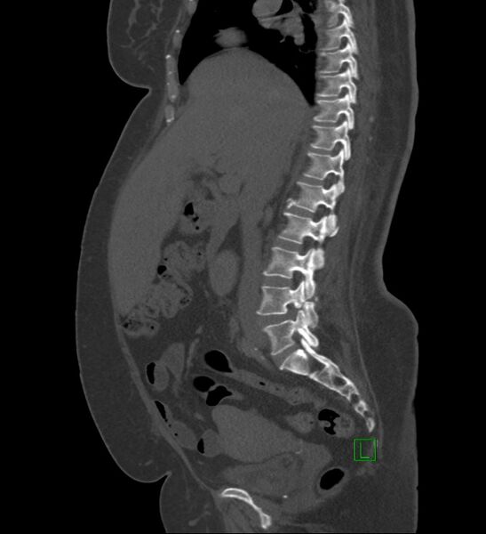 File:Chromophobe renal cell carcinoma (Radiopaedia 84239-99519 Sagittal bone window 63).jpg