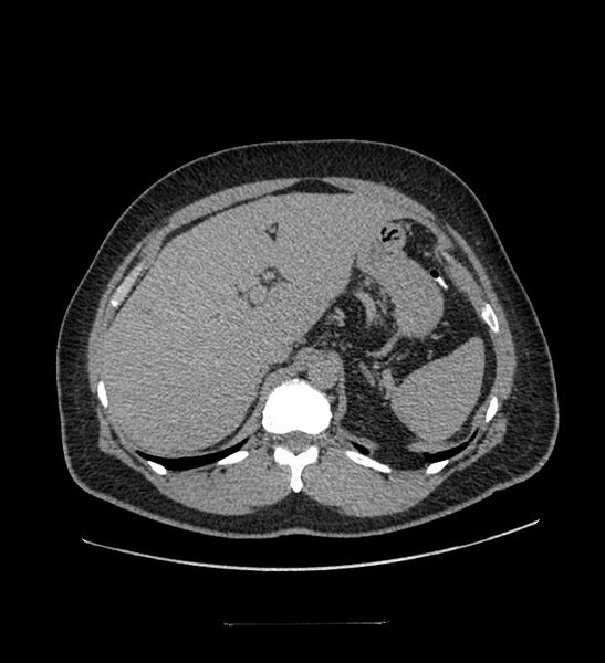 File:Chromophobe renal cell carcinoma (Radiopaedia 84337-99644 Axial C+ delayed 35).jpg