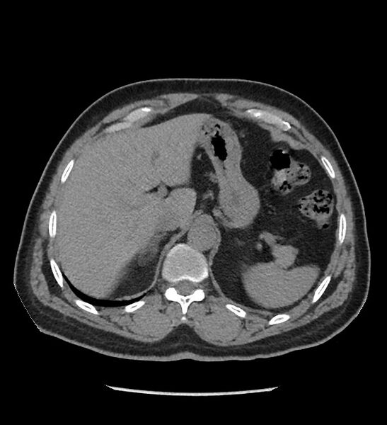 File:Chromophobe renal cell carcinoma (Radiopaedia 86879-103083 Axial non-contrast 13).jpg