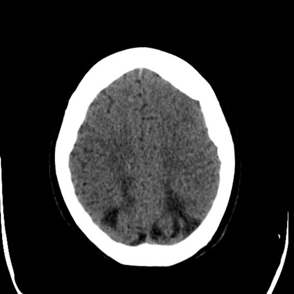 File:Chronic bilateral occipital lobe infarcts (Radiopaedia 31276-31996 Axial non-contrast 32).jpg