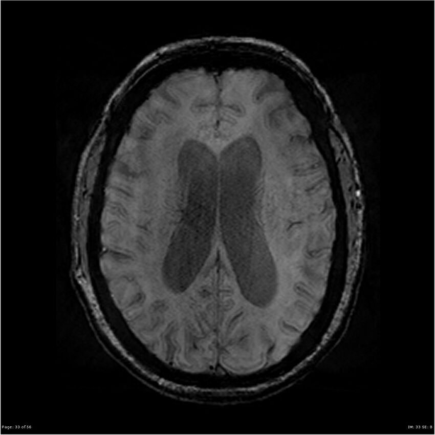 Chronic hypertensive encephalopathy (Radiopaedia 25764-25918 Axial SWI 33).jpg
