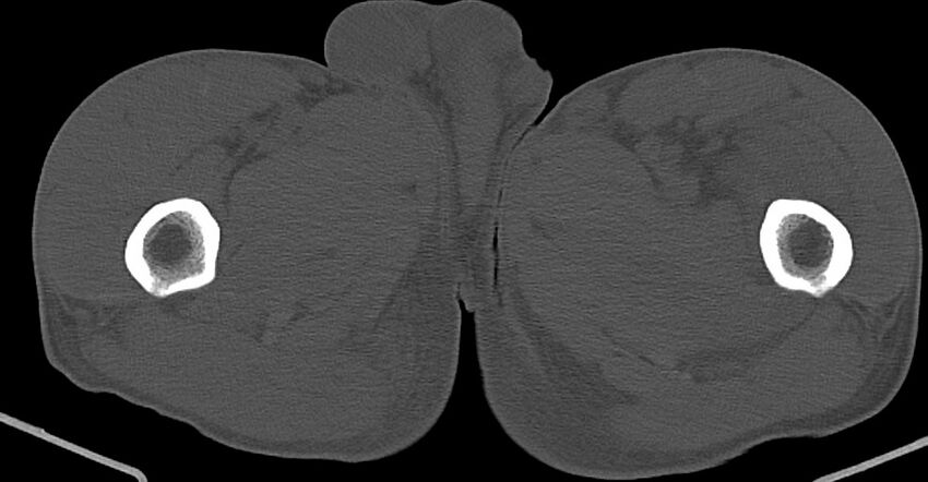 Chronic osteomyelitis (with sequestrum) (Radiopaedia 74813-85822 Axial non-contrast 64).jpg