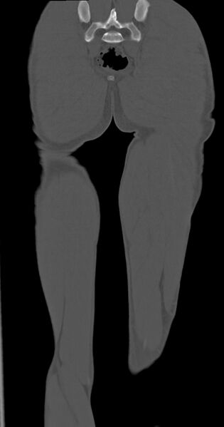 File:Chronic osteomyelitis (with sequestrum) (Radiopaedia 74813-85822 Coronal non-contrast 49).jpg
