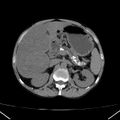 Chronic pancreatitis (Radiopaedia 23132-23172 Axial non-contrast 26).jpg