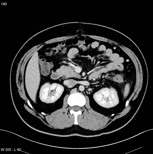 File:Chronic pancreatitis and pseudocysts (Radiopaedia 6724-7935 D 10).jpg