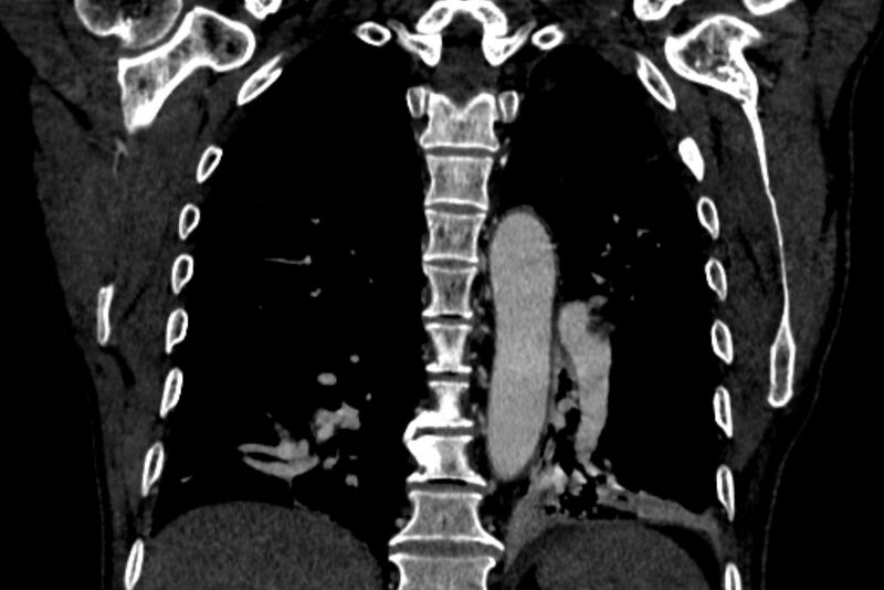 File:Chronic pulmonary embolism with bubbly consolidation (Radiopaedia 91248-108850 B 101).jpg