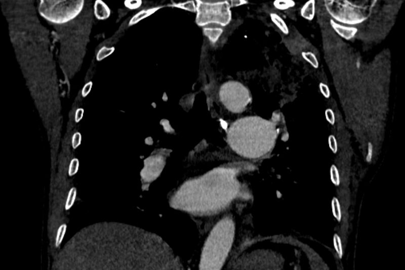 File:Chronic pulmonary embolism with bubbly consolidation (Radiopaedia 91248-108850 B 84).jpg
