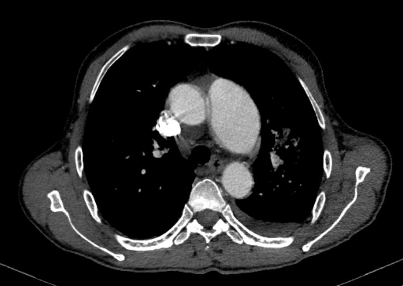 File:Chronic pulmonary embolism with bubbly consolidation (Radiopaedia 91248-108850 C+ arterial phase 49).jpg