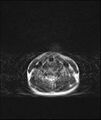 Chronic reactive multifocal osteomyelitis (CRMO) - mandible (Radiopaedia 56405-63069 Axial T2 1).jpg