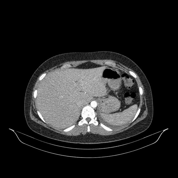 File:Chronic thromboembolic pulmonary hypertension (CTEPH) (Radiopaedia 74597-85532 Axial C+ CTPA 11).jpg
