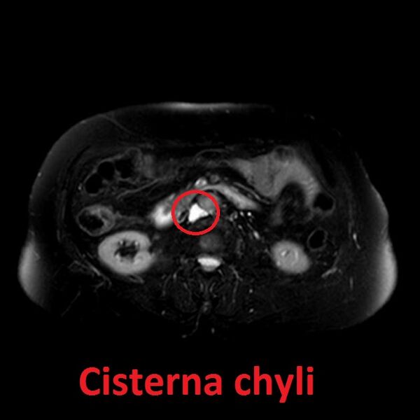 File:Cisterna chyli (Radiopaedia 25421-25664 F 1).jpg