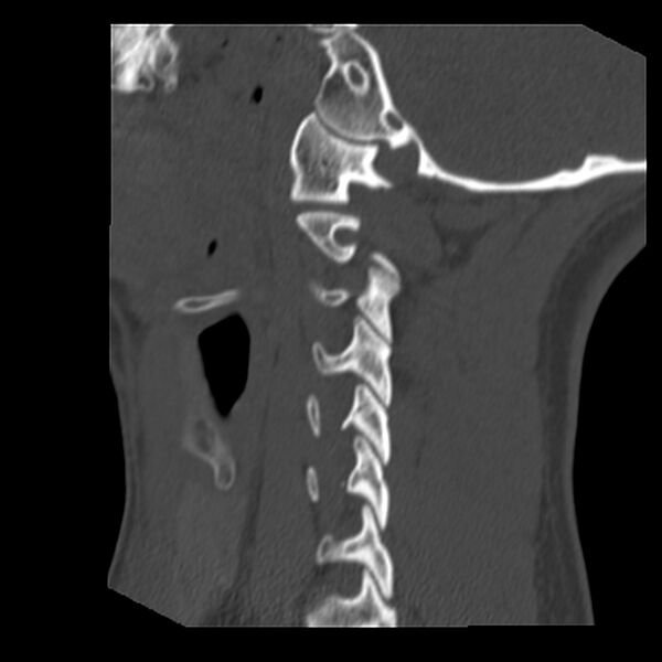 File:Clay-shoveler fracture (Radiopaedia 22568-22590 Sagittal bone window 36).jpg