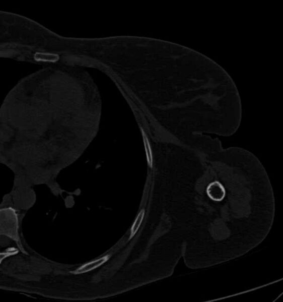 File:Clear cell chondrosarcoma - humerus (Radiopaedia 63104-71612 Axial bone window 92).jpg