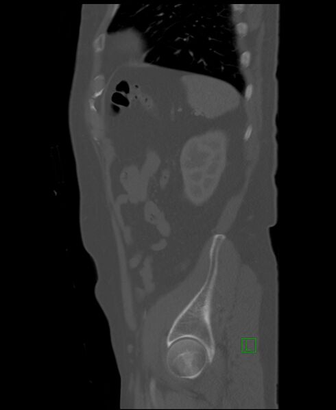 File:Clear cell renal cell carcinoma (Radiopaedia 85006-100539 Sagittal bone window 12).jpg