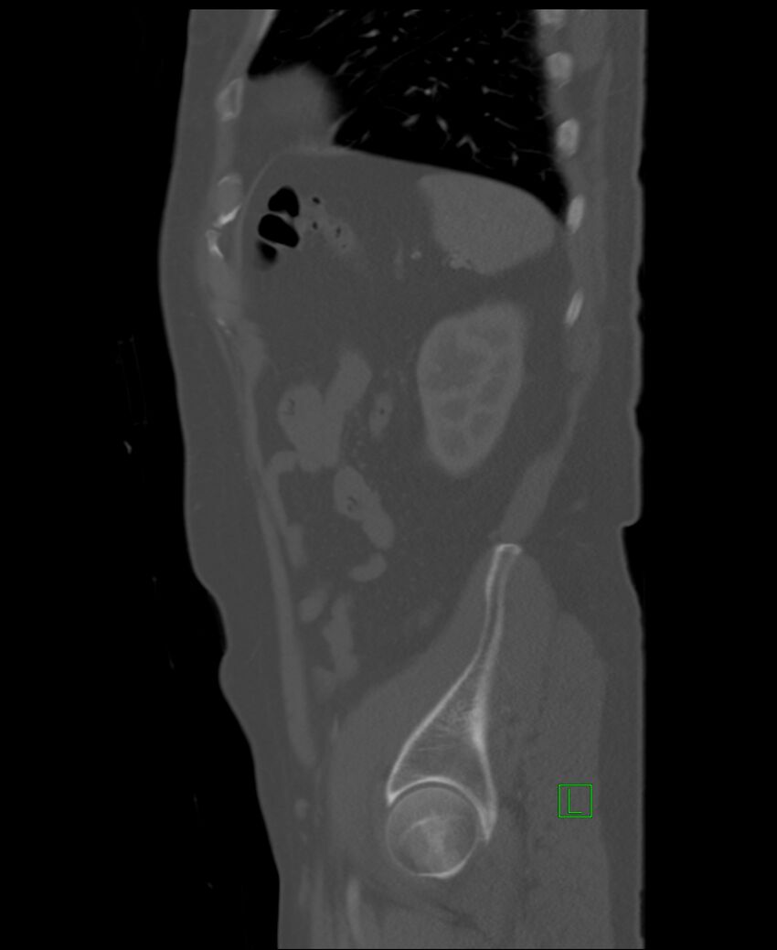 Clear cell renal cell carcinoma (Radiopaedia 85006-100539 Sagittal bone window 12).jpg