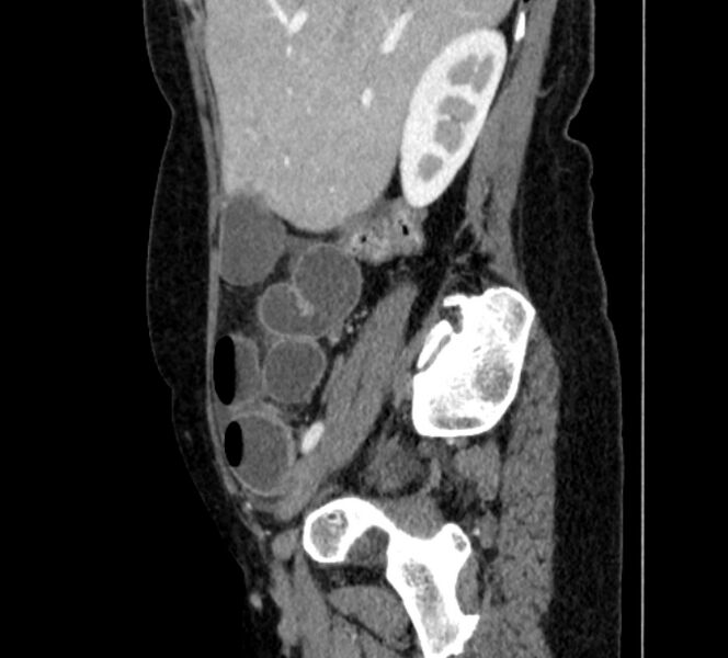 File:Closed loop small bowel obstruction (Radiopaedia 71211-81508 C 26).jpg