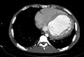 Coarctation of aorta with aortic valve stenosis (Radiopaedia 70463-80574 A 157).jpg