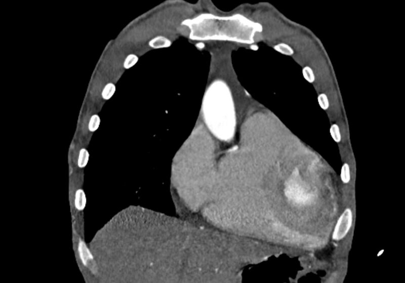 File:Coarctation of aorta with aortic valve stenosis (Radiopaedia 70463-80574 C 41).jpg