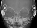 Cochlear implant (Radiopaedia 10069).jpg