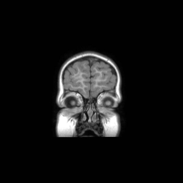 File:Cochlear nerve aplasia - unilateral (Radiopaedia 87910-104413 Coronal T1 6).jpg