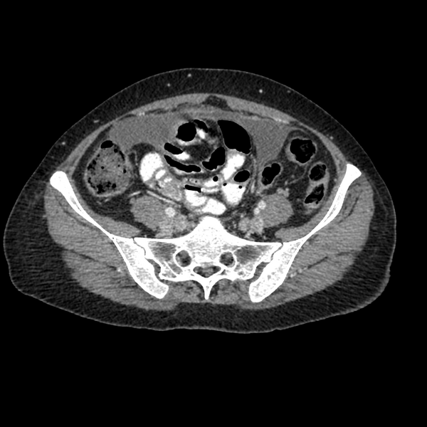 File:Cocoon abdomen with possible tubo-ovarian abscess (Radiopaedia 46235-50636 A 33).png