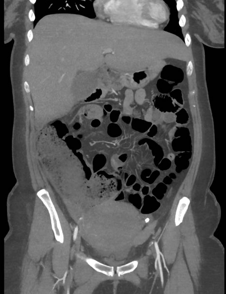File:Colonic pseudo-obstruction (Radiopaedia 79752-92980 B 27).png