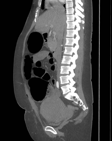 File:Colonic pseudo-obstruction (Radiopaedia 79752-92980 C 36).png