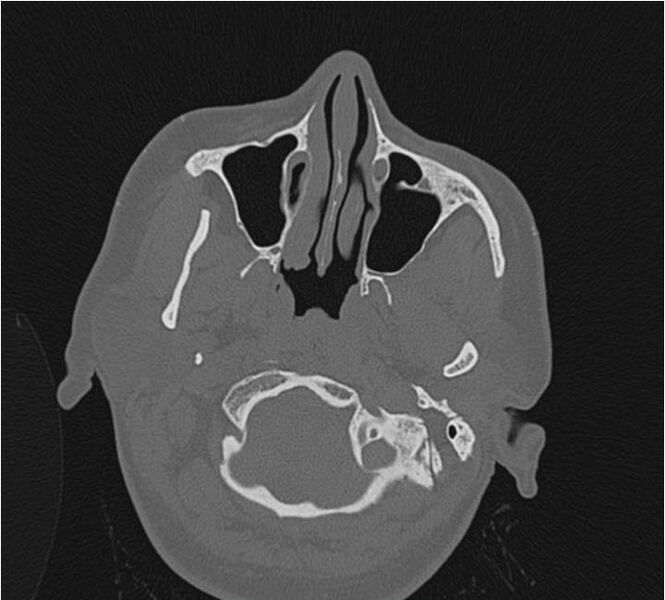 File:Nasolabial cyst (Radiopaedia 25322-25580 Axial bone window 11).jpg