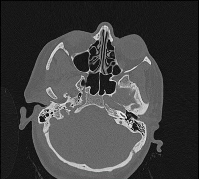 File:Nasolabial cyst (Radiopaedia 25322-25580 Axial bone window 18).jpg